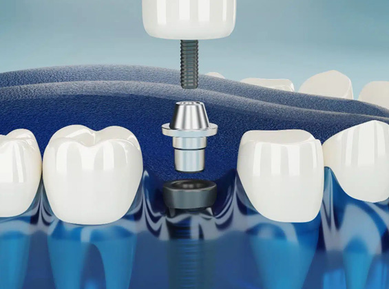 Dental Implant
