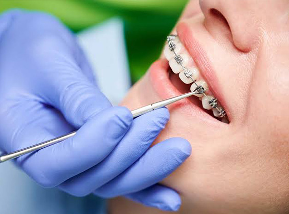 Orthodontic Treatment